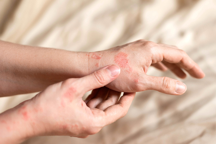 Eczema: Causes, Symptoms, Types, and Effective Management